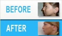nose reshaping photos nose reshaping photos
